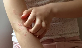 Existem várias causas de eczema atópico. Conheça.